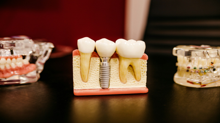 Are There Disadvantages to Dental Implants?