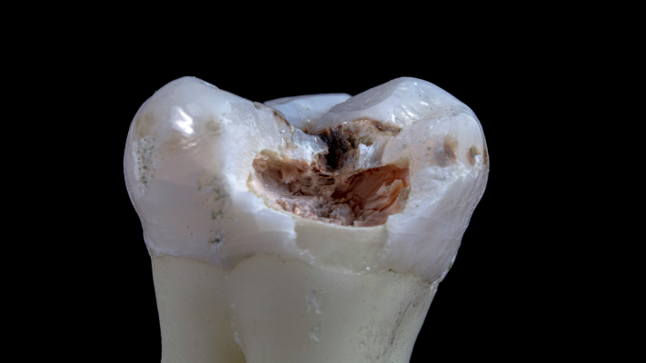 Tips to Help Prevent Dental Cavities