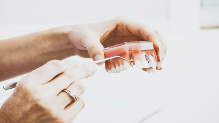 Dental Implant Procedure: What to Expect