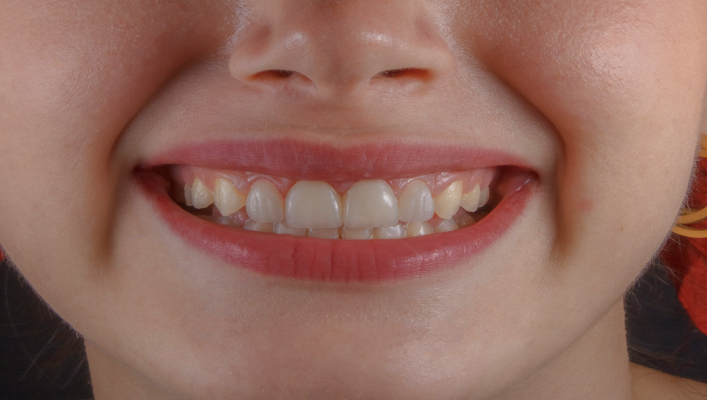 Latest Innovations in Dental Implants