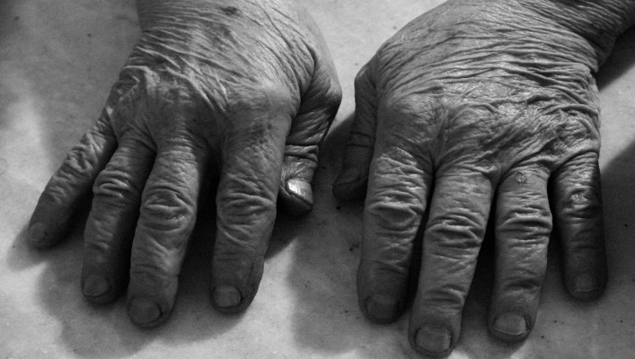 Psoriatic Arthritis vs Osteoarthritis