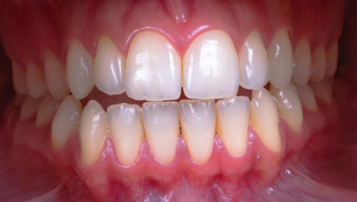 How to Prepare for Dental Implants