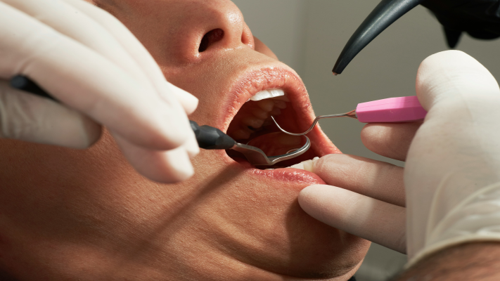 Dental Implant Procedure: What You Need to Know
