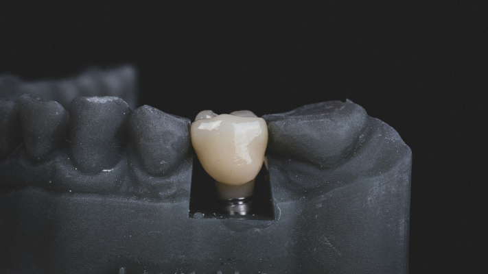 Dental Implants: Pros and Cons