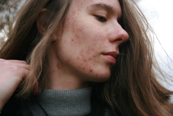 Treating Acne With Tretinoin