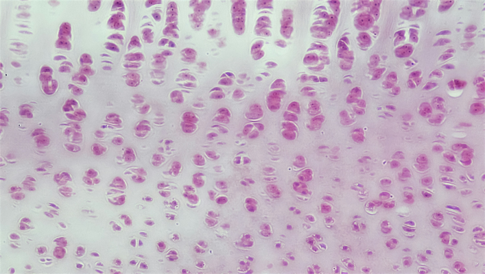 Lupus and Rheumatoid Arthritis: Key Differences